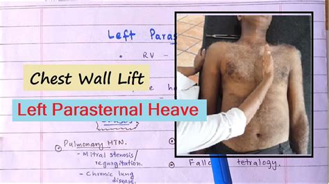 parasternal heave meaning